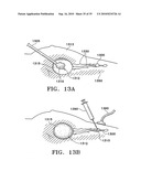 DEVICE AND METHOD FOR SAFE LOCATION AND MARKING OF A BIOPSY CAVITY diagram and image