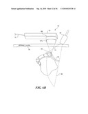 ULTRASOUND GUIDED HIGH INTENSITY FOCUSED ULTRASOUND TREATMENT OF NERVES diagram and image