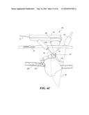 ULTRASOUND GUIDED HIGH INTENSITY FOCUSED ULTRASOUND TREATMENT OF NERVES diagram and image