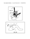 ULTRASOUND GUIDED HIGH INTENSITY FOCUSED ULTRASOUND TREATMENT OF NERVES diagram and image