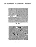 ULTRASOUND GUIDED HIGH INTENSITY FOCUSED ULTRASOUND TREATMENT OF NERVES diagram and image