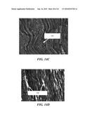 ULTRASOUND GUIDED HIGH INTENSITY FOCUSED ULTRASOUND TREATMENT OF NERVES diagram and image