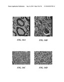 ULTRASOUND GUIDED HIGH INTENSITY FOCUSED ULTRASOUND TREATMENT OF NERVES diagram and image