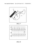 ULTRASOUND GUIDED HIGH INTENSITY FOCUSED ULTRASOUND TREATMENT OF NERVES diagram and image