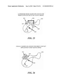 ULTRASOUND GUIDED HIGH INTENSITY FOCUSED ULTRASOUND TREATMENT OF NERVES diagram and image