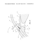 OCULAR IMPLANT WITH THERAPEUTIC AGENTS AND METHODS THEREOF diagram and image