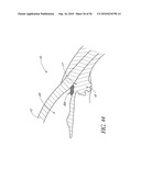 OCULAR IMPLANT WITH THERAPEUTIC AGENTS AND METHODS THEREOF diagram and image