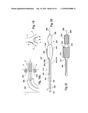 VESSEL TREATMENT DEVICES diagram and image