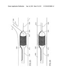 VESSEL TREATMENT DEVICES diagram and image