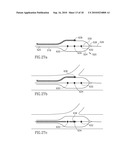 VESSEL TREATMENT DEVICES diagram and image