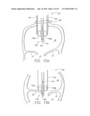 MINIMALLY INVASIVE MITRAL VALVE REPAIR METHOD AND APPARATUS diagram and image