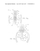 MINIMALLY INVASIVE MITRAL VALVE REPAIR METHOD AND APPARATUS diagram and image