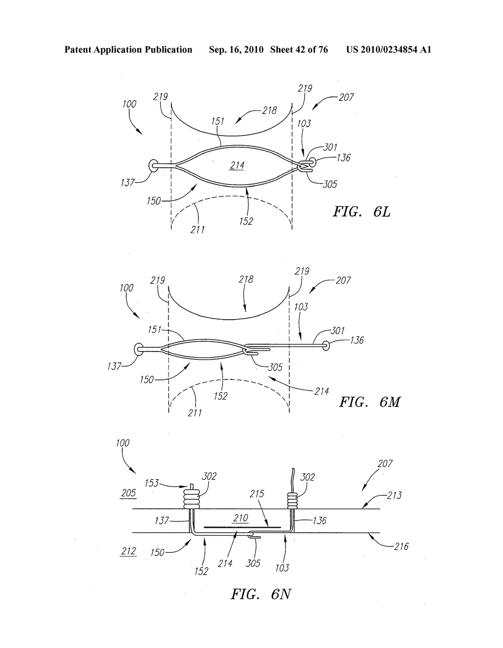 Systems and Methods for Treating Septal Defects with Capture Devices and Other Devices - diagram, schematic, and image 43