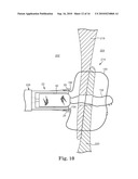 SYSTEM AND METHOD FOR CATHETER-BASED SEPTAL DEFECT REPAIR diagram and image