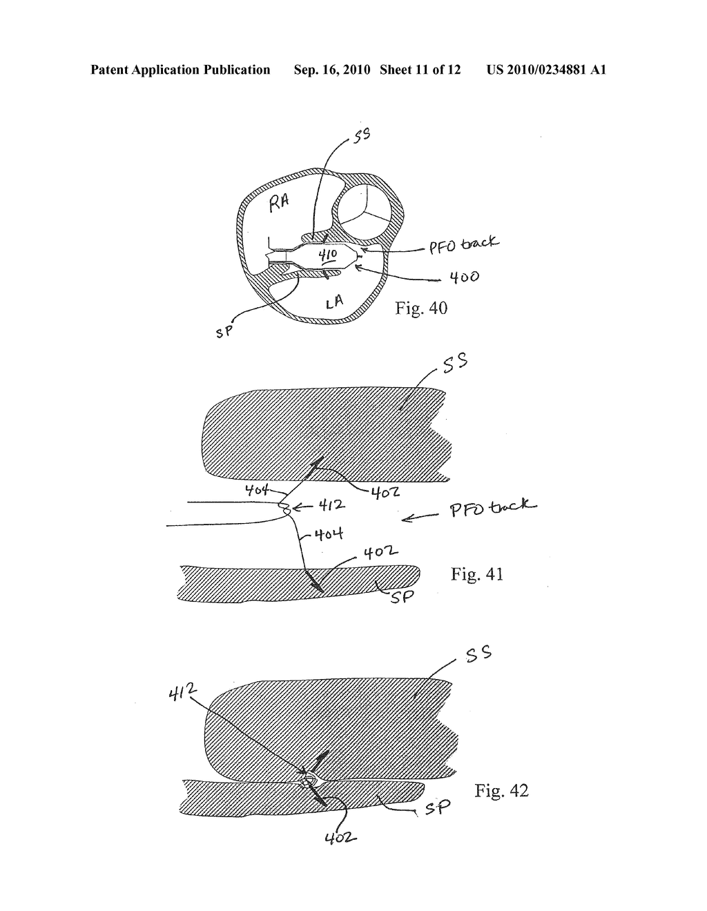 PFO CLOSURE DEVICES AND RELATED METHODS OF USE - diagram, schematic, and image 12