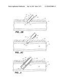 CLOSURE DEVICE WITH TEXTURED SURFACE diagram and image