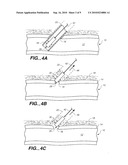 CLOSURE DEVICE WITH TEXTURED SURFACE diagram and image