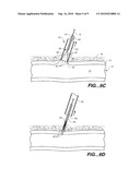 CLOSURE DEVICE WITH TEXTURED SURFACE diagram and image