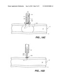 CLOSURE DEVICE WITH TEXTURED SURFACE diagram and image