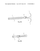 METHOD FOR SECURING MEDICAL DEVICES TO TREAT OBESITY, GASTRO-ESOPHAGEAL REFLUX DISEASE (GERD) AND IRRITABLE BOWEL SYNDROME (iBS) REVERSIBLY diagram and image