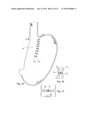 METHOD FOR SECURING MEDICAL DEVICES TO TREAT OBESITY, GASTRO-ESOPHAGEAL REFLUX DISEASE (GERD) AND IRRITABLE BOWEL SYNDROME (iBS) REVERSIBLY diagram and image