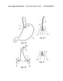 METHOD FOR SECURING MEDICAL DEVICES TO TREAT OBESITY, GASTRO-ESOPHAGEAL REFLUX DISEASE (GERD) AND IRRITABLE BOWEL SYNDROME (iBS) REVERSIBLY diagram and image