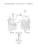 METHOD FOR SECURING MEDICAL DEVICES TO TREAT OBESITY, GASTRO-ESOPHAGEAL REFLUX DISEASE (GERD) AND IRRITABLE BOWEL SYNDROME (iBS) REVERSIBLY diagram and image