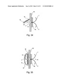 METHOD FOR SECURING MEDICAL DEVICES TO TREAT OBESITY, GASTRO-ESOPHAGEAL REFLUX DISEASE (GERD) AND IRRITABLE BOWEL SYNDROME (iBS) REVERSIBLY diagram and image