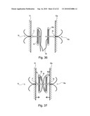 METHOD FOR SECURING MEDICAL DEVICES TO TREAT OBESITY, GASTRO-ESOPHAGEAL REFLUX DISEASE (GERD) AND IRRITABLE BOWEL SYNDROME (iBS) REVERSIBLY diagram and image