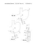 Digestive Organ Retention Device diagram and image