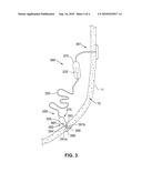 Digestive Organ Retention Device diagram and image