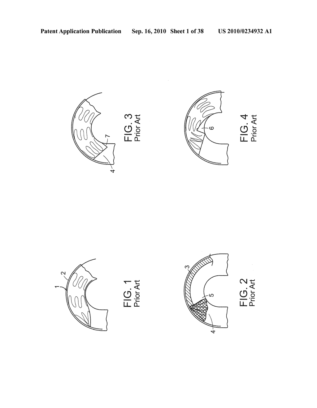 SYSTEM AND METHOD FOR DEPLOYING AN ENDOLUMINAL PROSTHESIS AT A SURGICAL SITE - diagram, schematic, and image 02