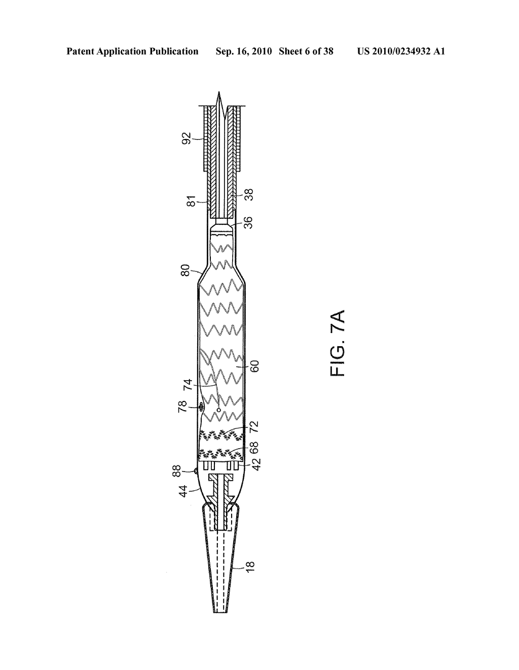 SYSTEM AND METHOD FOR DEPLOYING AN ENDOLUMINAL PROSTHESIS AT A SURGICAL SITE - diagram, schematic, and image 07