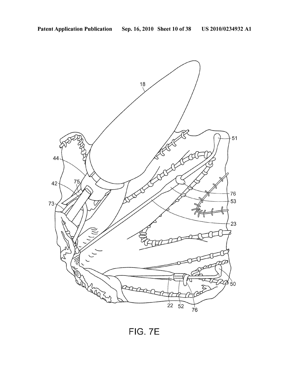 SYSTEM AND METHOD FOR DEPLOYING AN ENDOLUMINAL PROSTHESIS AT A SURGICAL SITE - diagram, schematic, and image 11