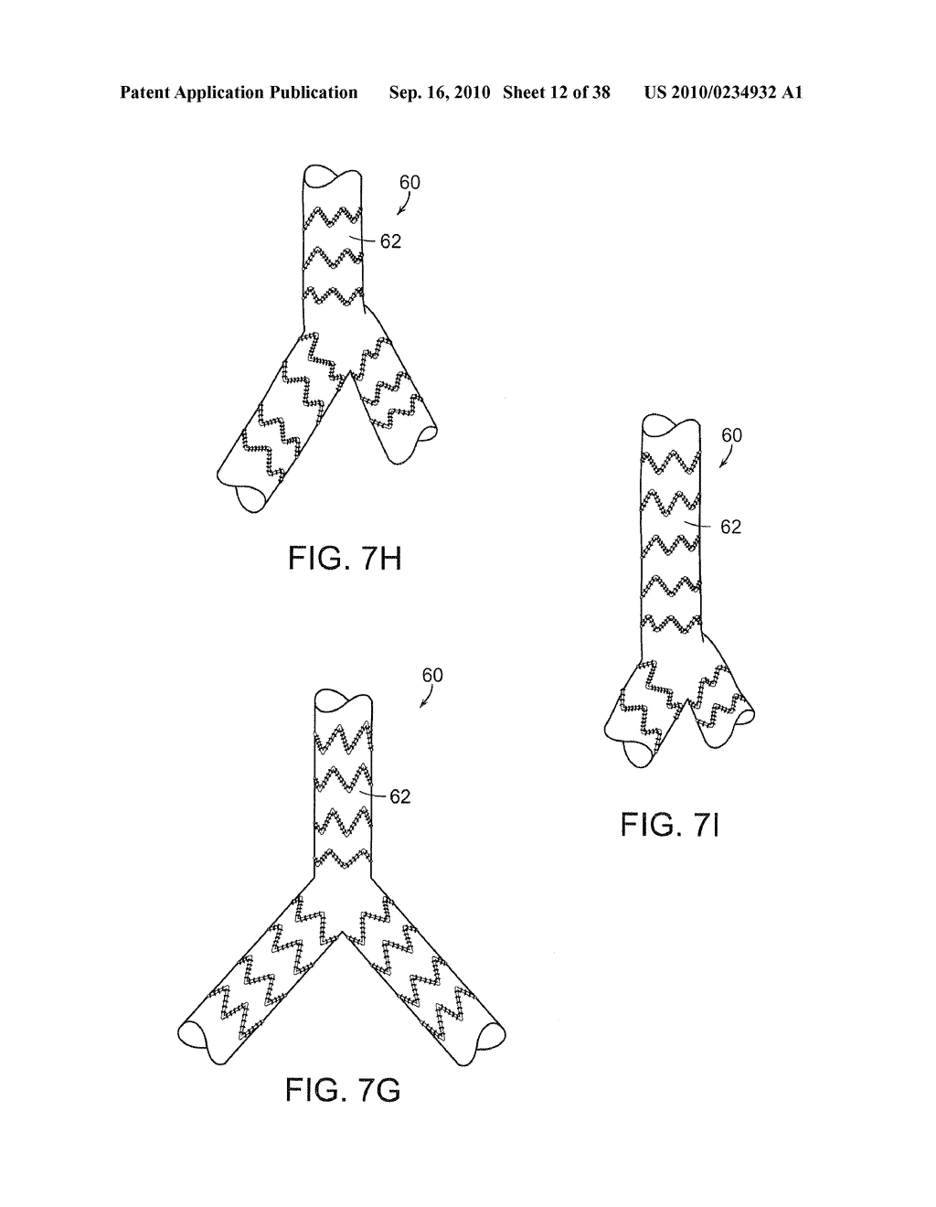 SYSTEM AND METHOD FOR DEPLOYING AN ENDOLUMINAL PROSTHESIS AT A SURGICAL SITE - diagram, schematic, and image 13