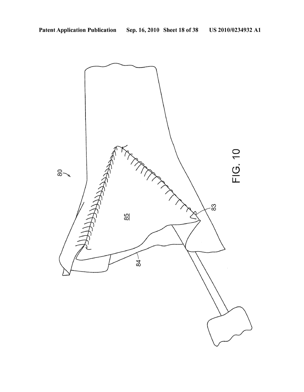 SYSTEM AND METHOD FOR DEPLOYING AN ENDOLUMINAL PROSTHESIS AT A SURGICAL SITE - diagram, schematic, and image 19