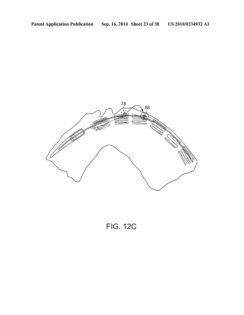 SYSTEM AND METHOD FOR DEPLOYING AN ENDOLUMINAL PROSTHESIS AT A SURGICAL SITE - diagram, schematic, and image 24