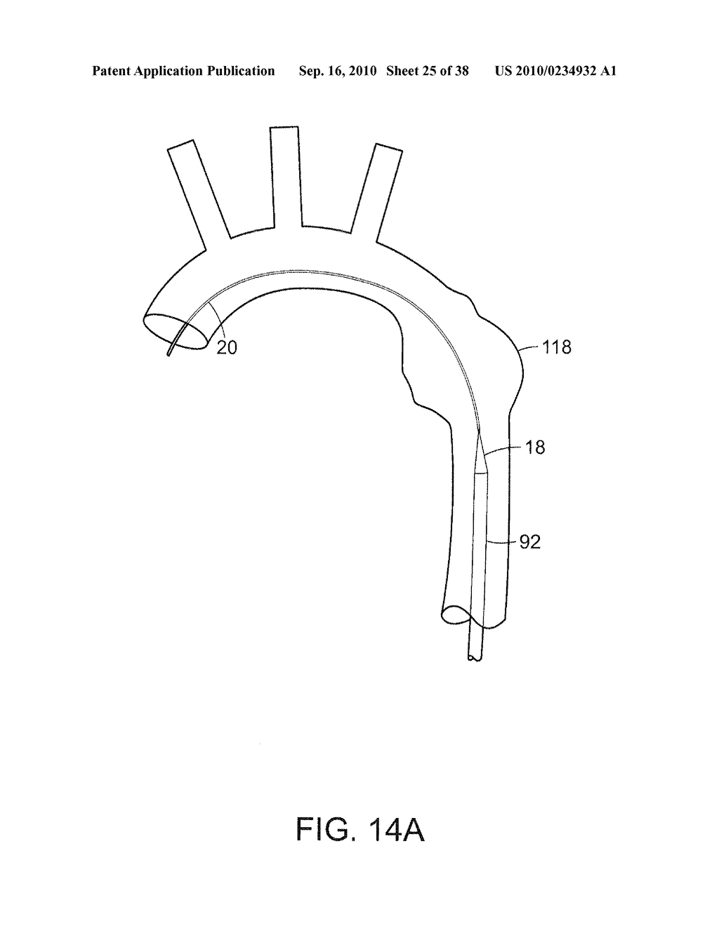 SYSTEM AND METHOD FOR DEPLOYING AN ENDOLUMINAL PROSTHESIS AT A SURGICAL SITE - diagram, schematic, and image 26