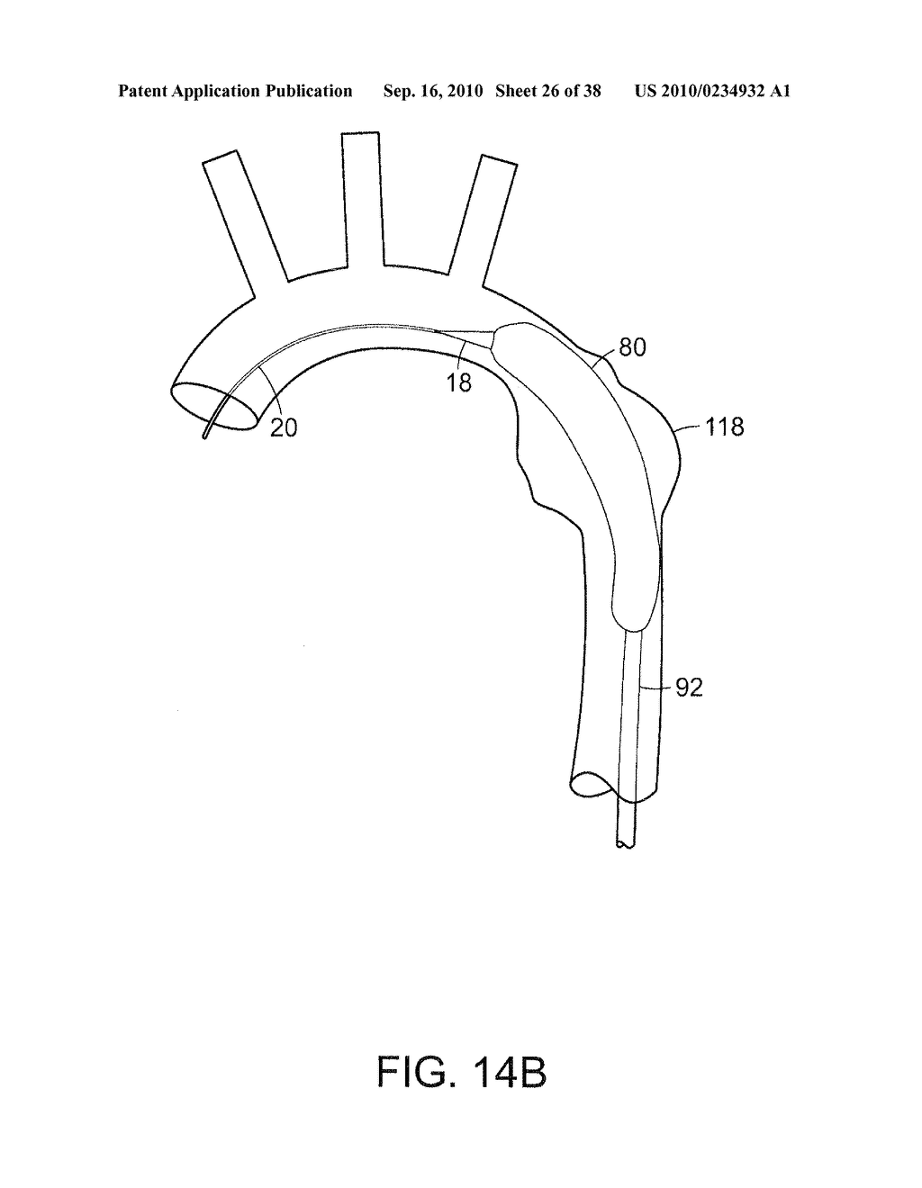 SYSTEM AND METHOD FOR DEPLOYING AN ENDOLUMINAL PROSTHESIS AT A SURGICAL SITE - diagram, schematic, and image 27
