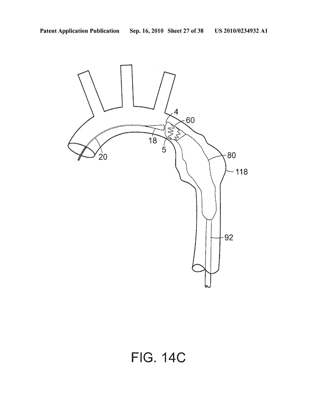 SYSTEM AND METHOD FOR DEPLOYING AN ENDOLUMINAL PROSTHESIS AT A SURGICAL SITE - diagram, schematic, and image 28
