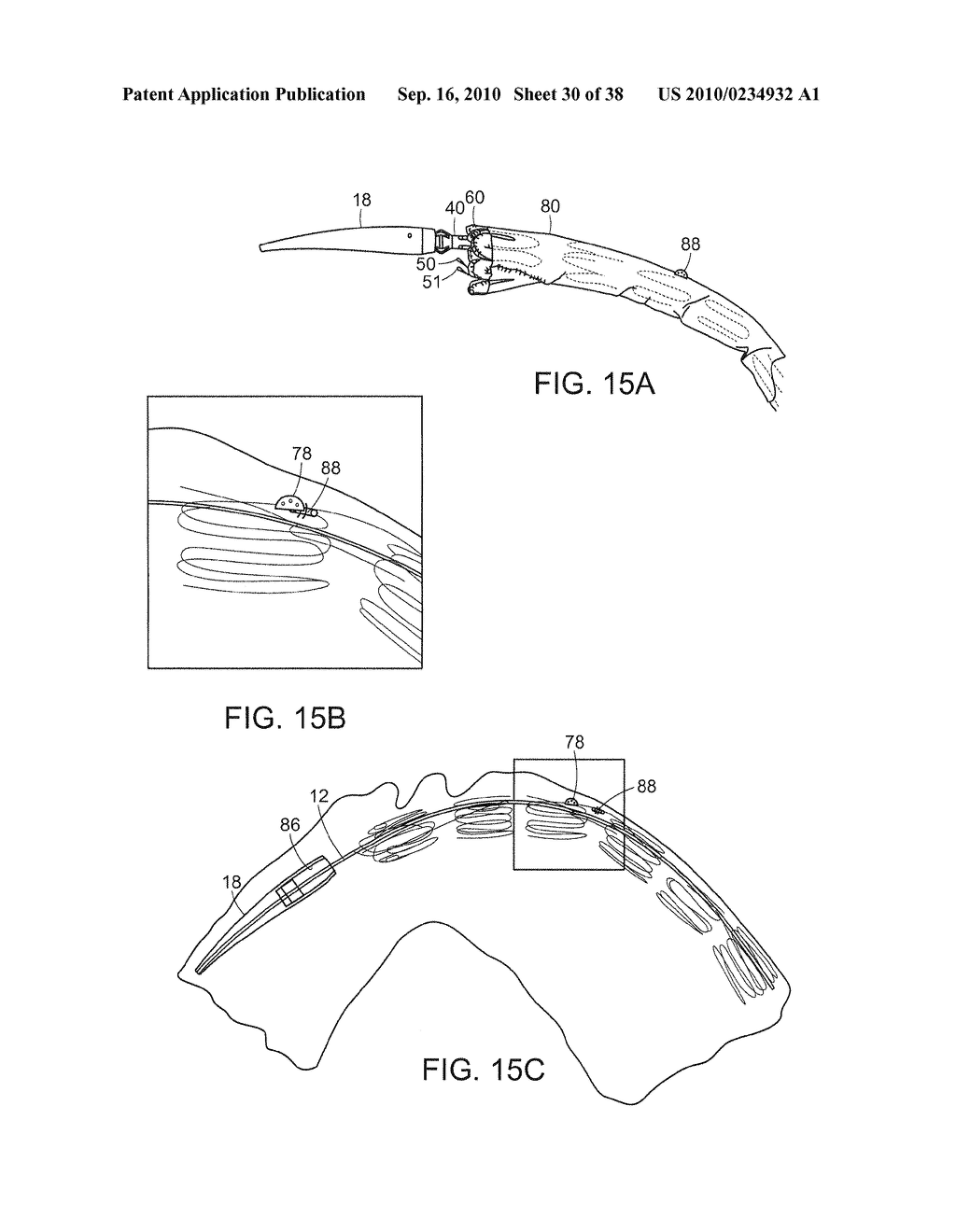 SYSTEM AND METHOD FOR DEPLOYING AN ENDOLUMINAL PROSTHESIS AT A SURGICAL SITE - diagram, schematic, and image 31