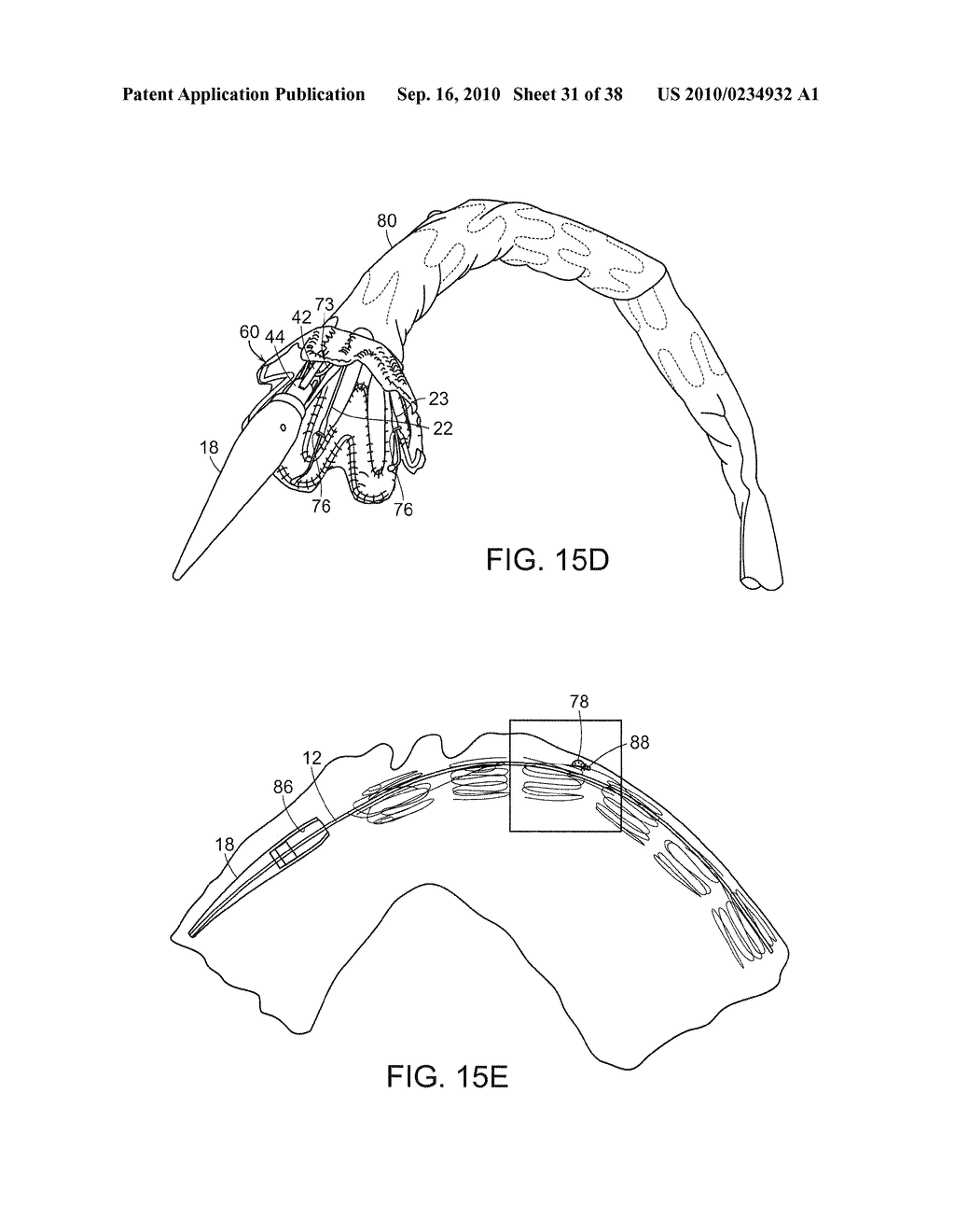 SYSTEM AND METHOD FOR DEPLOYING AN ENDOLUMINAL PROSTHESIS AT A SURGICAL SITE - diagram, schematic, and image 32