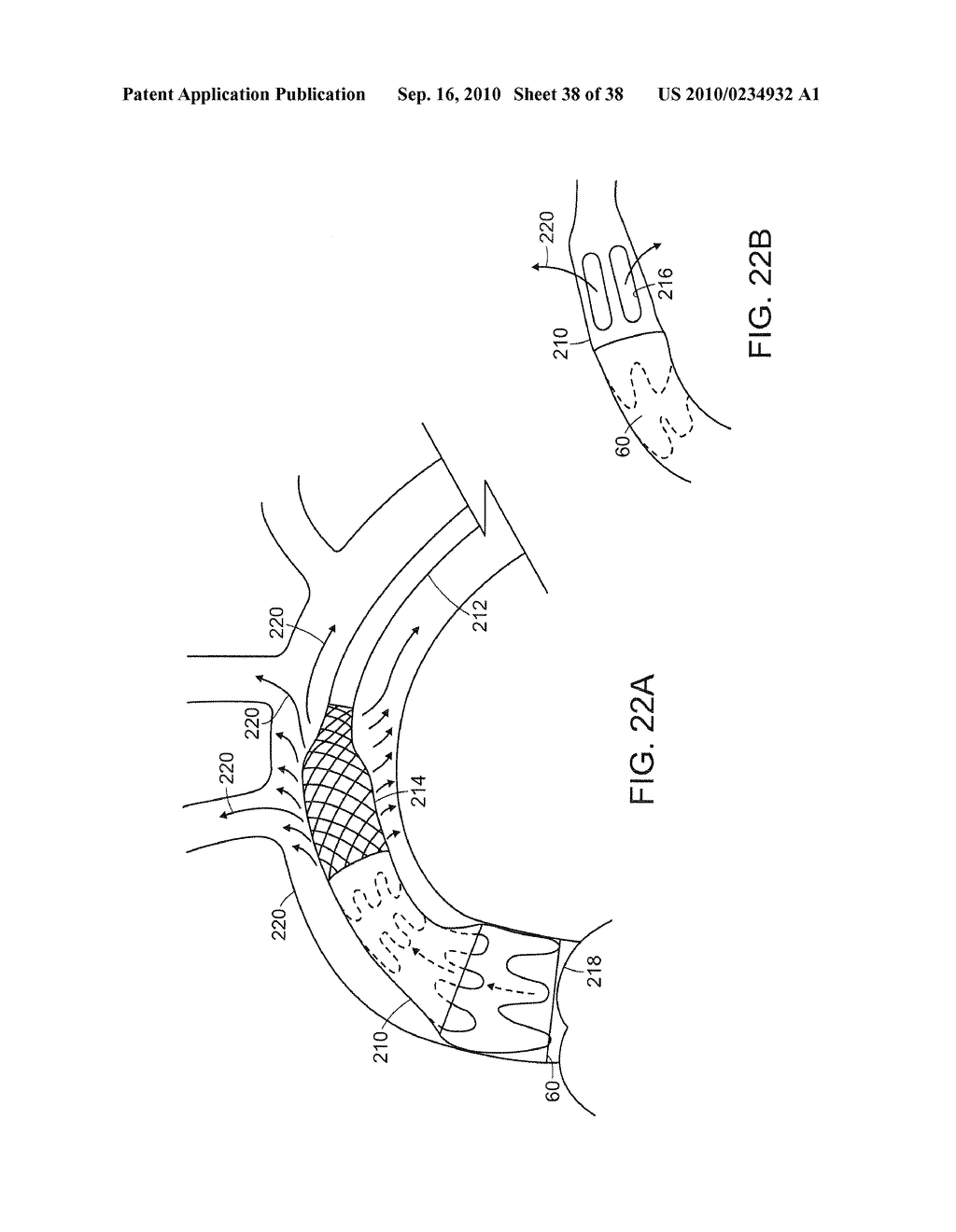 SYSTEM AND METHOD FOR DEPLOYING AN ENDOLUMINAL PROSTHESIS AT A SURGICAL SITE - diagram, schematic, and image 39