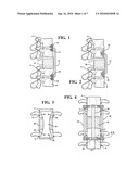 COMBINATION SPACER INSERT AND SUPPORT FOR PROVIDING INTER-CERVICAL VERTEBRAL SUPPORT diagram and image