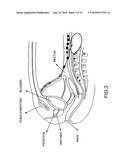 METHOD AND DEVICE FOR IMAGE GUIDED DYNAMIC RADIATION TREATMENT OF PROSTATE CANCER AND OTHER PELVIC LESIONS diagram and image