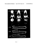 Lipid Hydrolysis Therapy for Atherosclerosis and Related Diseases diagram and image