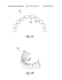 DENTAL WIRE ATTACHMENT diagram and image