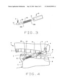 Jaw advancer connected to bone diagram and image