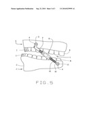 Jaw advancer connected to bone diagram and image