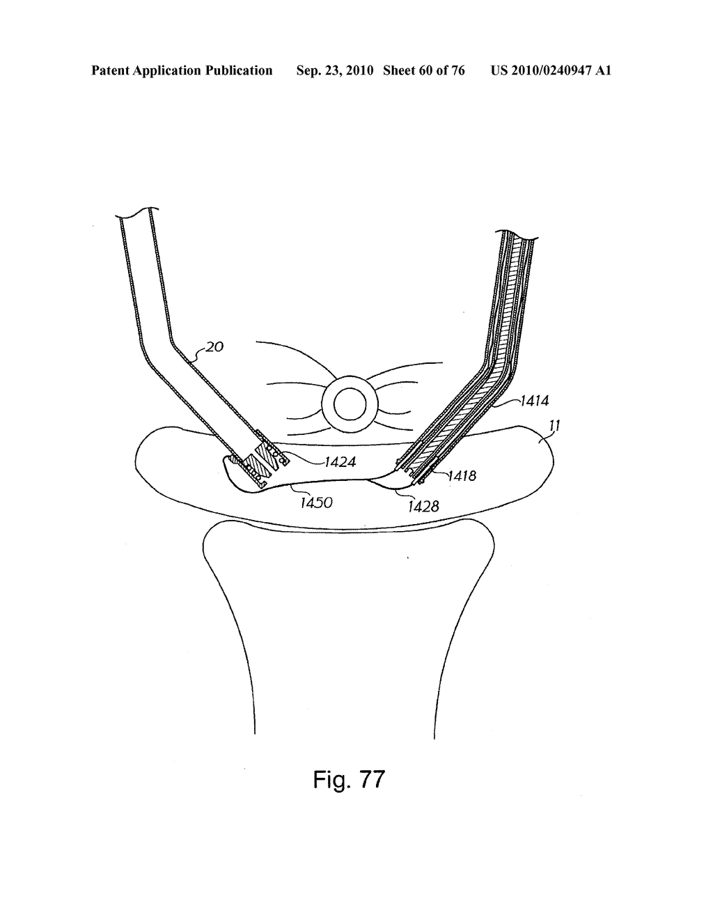 DEVICES FOR MINIMALLY INVASIVE PELVIC SURGERY - diagram, schematic, and image 61